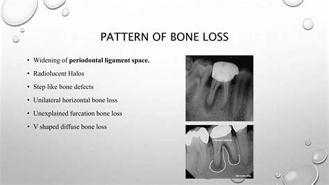 Vertical Root Fractures PPT