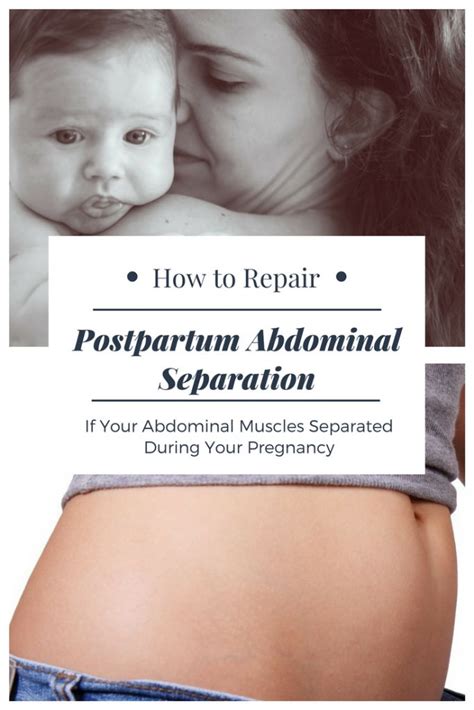 What Is The MuTu System Will It Heal Abdominal Separation The