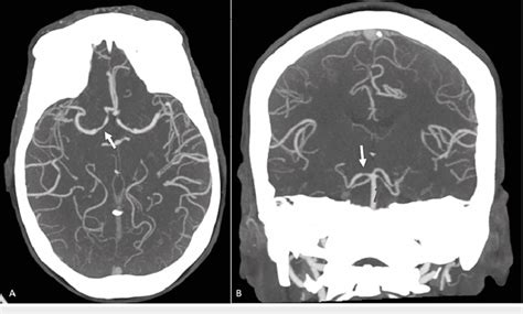 Axial And Coronal MIP Post Contrast CTA Image Of The Head A Axial MIP