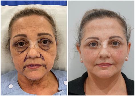 Face And Neck Lift Gallery The Plastic Surgery Clinic