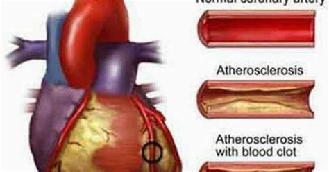 Infark Miokard Akut Ima Myocardial Infarction Medical Articles