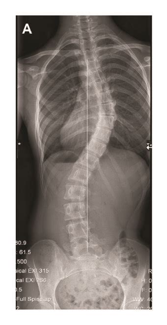 A 15 Year Old Female With Lenke 1cn Adolescent Idiopathic Scoliosis Download Scientific Diagram