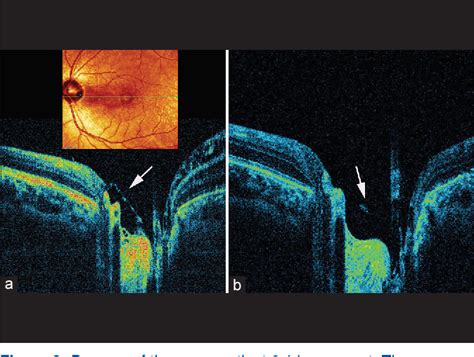 Figure 1 From Spectral Domain Optical Coherence Tomography Morphology In Optic Disc Pit