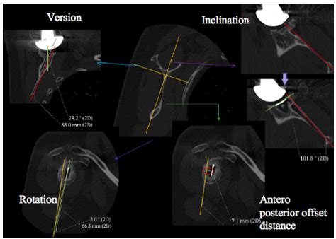 Definition of the three the humeral head component positioning... | Download Scientific Diagram