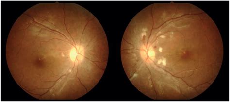 Optic disc photo of both the eyes showing optic disc edema with... | Download Scientific Diagram