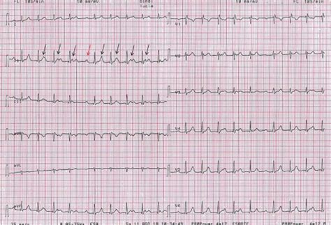 Surface Electrocardiogram Recording Cardiac Electrophysiology Clinics