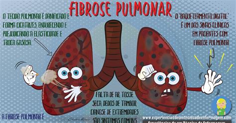 A Fibrose Pulmonar Enfermagem Ilustrada Fibrose Pulmonar Pulmonar 66690