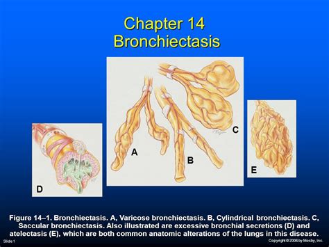 Saccular Bronchiectasis Understanding Causes Symptoms And Treatment Options