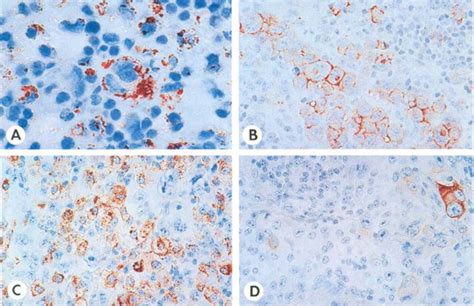 True Malignant Histiocytosis Mayo Clinic Proceedings