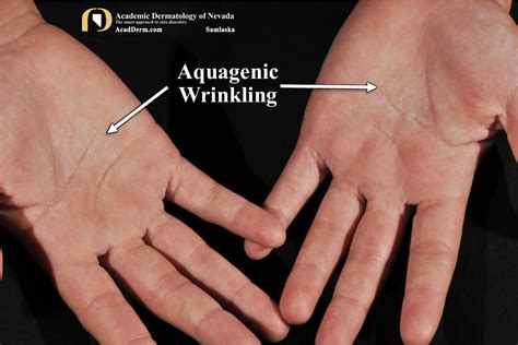 Aquagenic Wrinkling It Burns Academic Dermatology Of Nevada