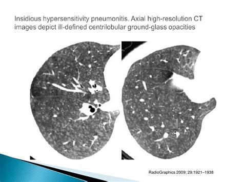 Hypersensitivity pneumonitis