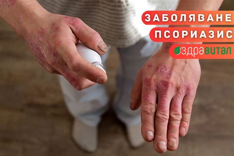 Псориазис