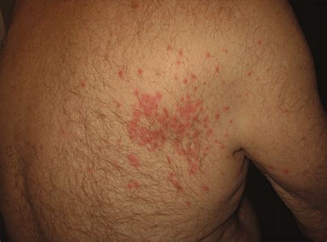 papular rashes - pictures, photos