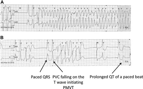 Premature Ventricular Contractioninduced Polymorphic Ventricular Tachycardia After Leadless