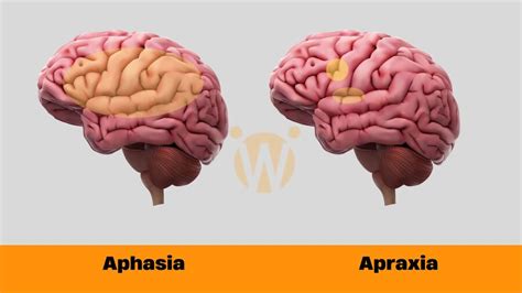 Understand Aphasia And Apraxia Improve Speech