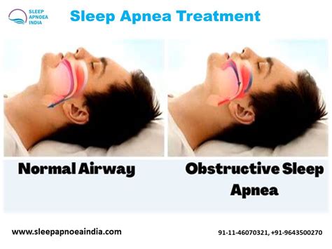 Sleep Apnea Treatment - SC Classifieds