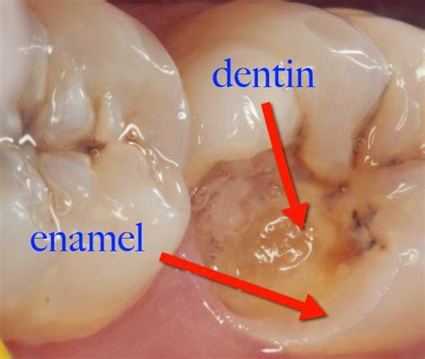 Omni Dental Group Dentin Decay