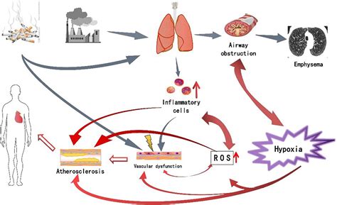 Current Views In Chronic Obstructive Pulmonary Disease 48 OFF