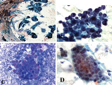 Poorly Differentiated Thyroid Carcinoma A A Low Magnification View