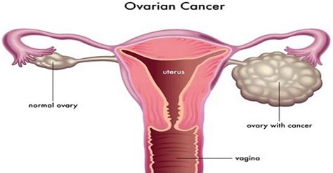 Ovarian Cancer Causes Symptoms Diagnosis Survival Rate And Treatment