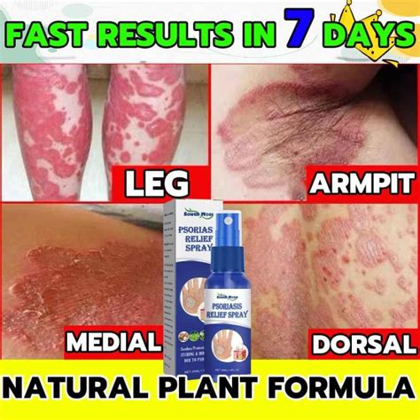 Antibacterial Psoriasis Cream Herbal Treatment Eczema Relief Itch Rash