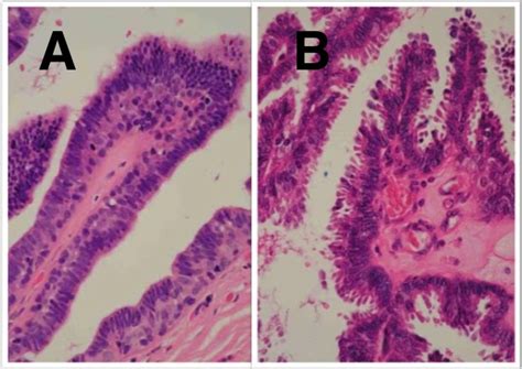 What Is Intraductal Papilloma And How To Remove It Effectively