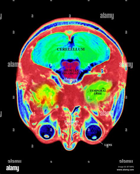 Scansione Del Cervello Mri Immagini E Fotos Stock Alamy