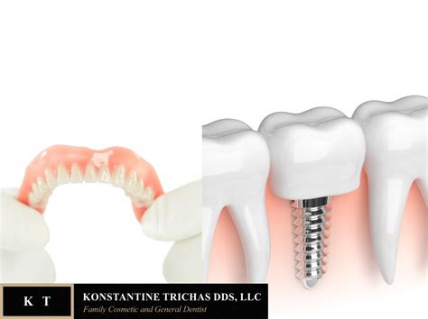 Benefits of Dentures vs. Implants | Dr. Trichas