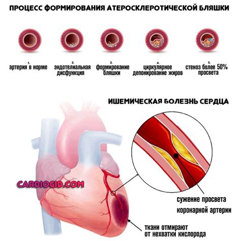 Гипертония 3 степени: симптомы, лечение и риски 1-4