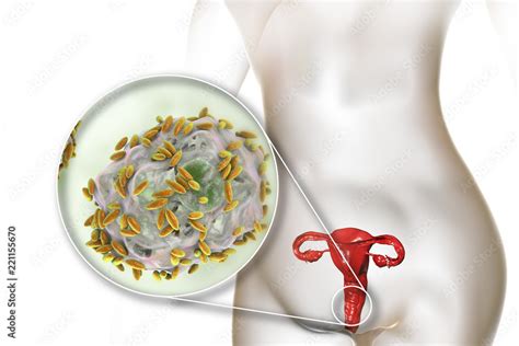 Bacterial Vaginosis Vaginal Secretions Contain Epithelial Cells So Called Clue Cells Covered