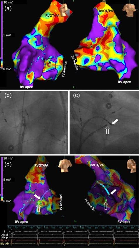 A Electroanatomical Voltage Map Of The Right Ventricular Endocardium