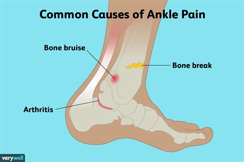 Ankle Pain Causes And Treatments