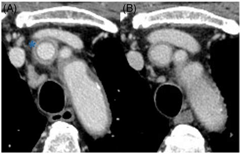 Venous Phase Of Enhanced Computed Tomography Ct Findings A Ct