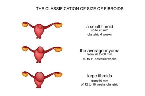 Fibroid Size Classification Usa Fibroid Centers