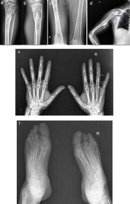 A And B Lytic Lesion Of The Proximal Part Of The Tibia And Erosion Download Scientific