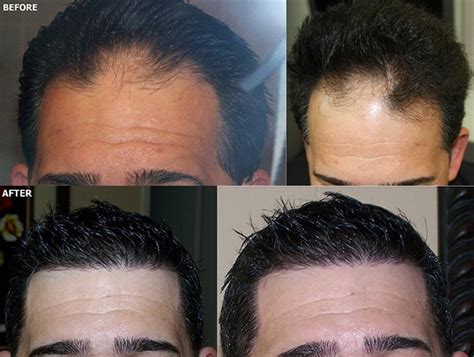 Fue Hairline Hair Restoration 2970 Grafts Alvi Armani Hair Transplant Los Angeles