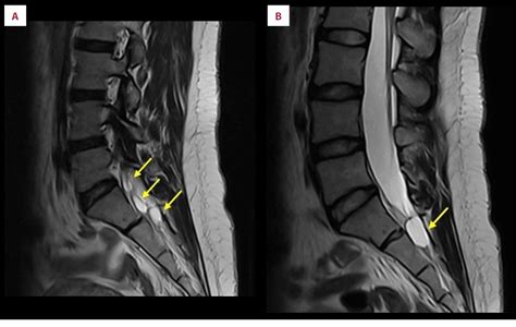 Figure From A Hidden Condition Multiple Tarlov Cysts Unveiled In A