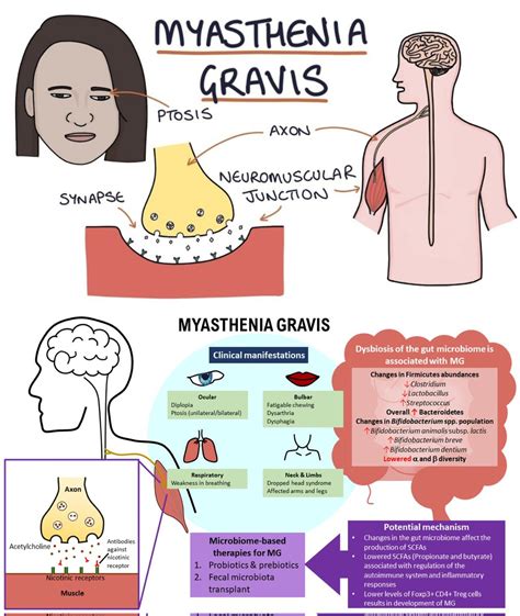 Sthanu On Twitter Myasthenia Gravis Curtain Sign When Mg Occurs