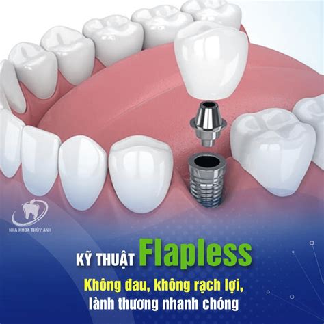 Kỹ thuật trồng răng implant Flapless không rạch lợi không đau Nha