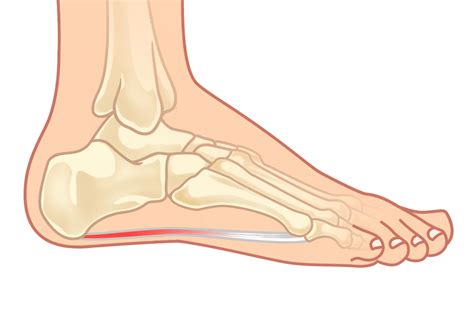 Plantar Fasciitis The Complete Treatment Guide Kintec