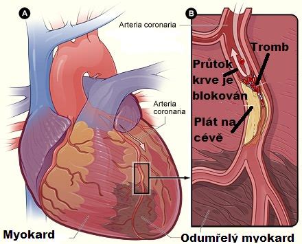 Akutní infarkt myokardu