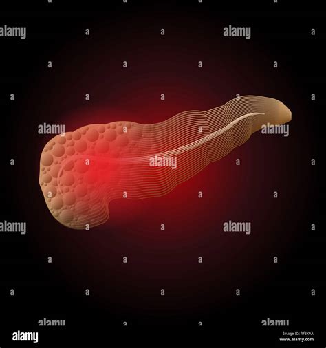 Medical Illustration Of Diseases Of The Pancreas Of A Real Organ To X