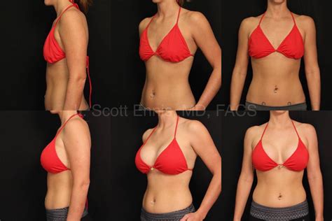 Before And After Plastic Surgery Breast Augmentation