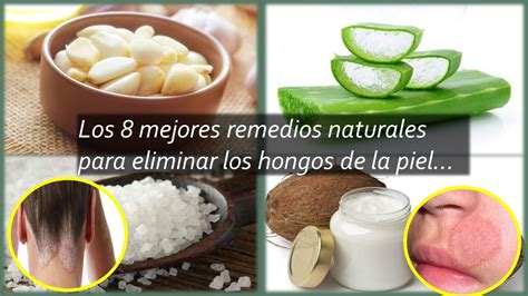 Los Mejores Remedios Naturales Para Eliminar Los Hongos De La Piel