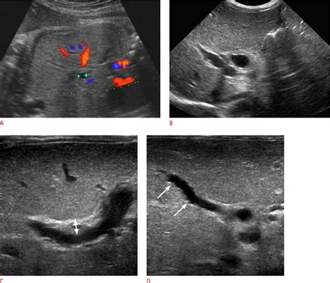 Figure From Key Imaging Features For Differentiating Cystic Biliary