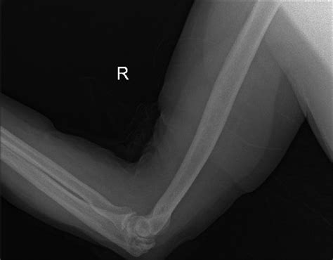 Ipsilateral Shoulder And Elbow Dislocation Camel Bite Related Injury