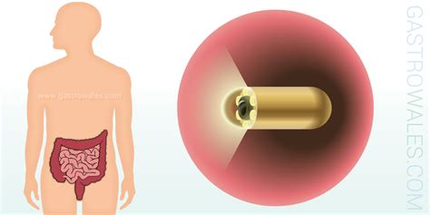 What Is Capsule Endoscopy