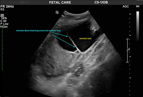 Amniotic Band Syndrome ABS