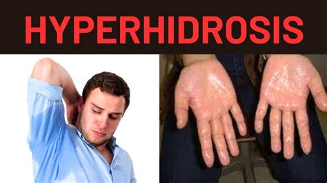 HYPERHIDROSIS CAUSES, SYMPTOMS, TREATMENT, TYPES - YouTube