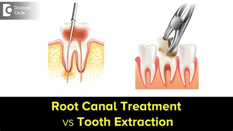 Root Canal Treatment Vs Tooth Extraction Which One Is Better Dr